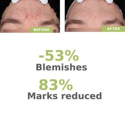 Aderma Biology AC Night Peel Serum 30ML