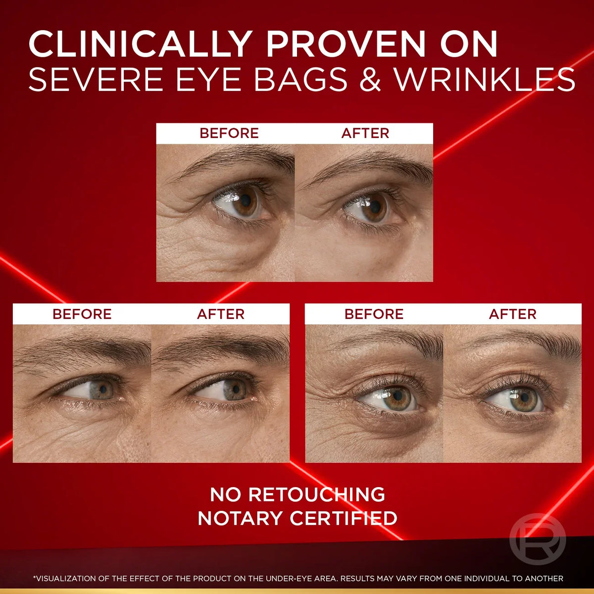 Loreal Revitalift Laser Instant Eye Bag Eraser 15ML
